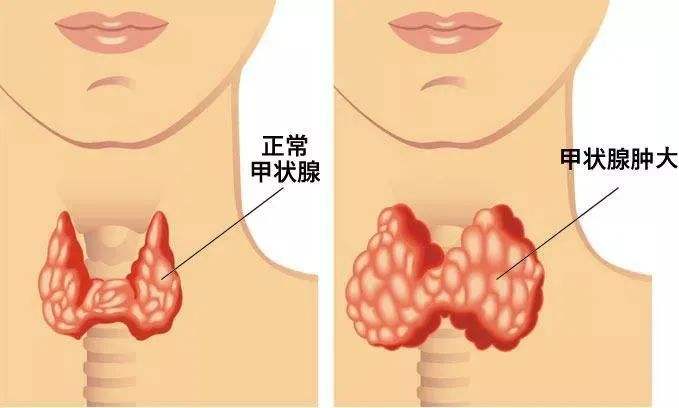患有甲状腺疾病的人 大多有这几个行为